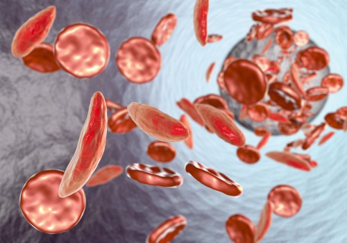 Difference Between Sickle Cell Anemia and Disease: Why the Right Terminology Can Improve Support and Awareness